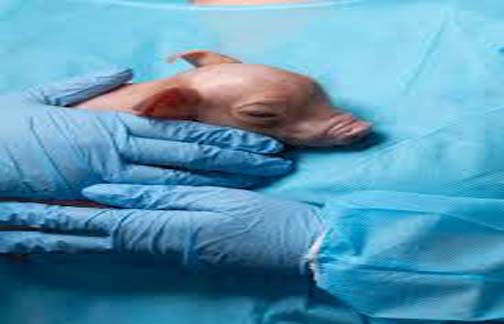 मनुष्य में सुअर का गुर्दा प्रतिरोपित किए जाने संबंधी पहला नैदानिक परीक्षण किया गया